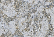 IHC staining of FFPE human gastric cancer with Elongation factor 2 antibody. HIER: boil tissue sections in pH8 EDTA for 20 min and allow to cool before testing.