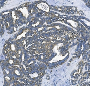 IHC staining of FFPE human ovarian cancer with Elongation factor 2 antibody. HIER: boil tissue sections in pH8 EDTA for 20 min and allow to cool before testing.
