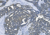 IHC staining of FFPE human ovarian cancer with Elongation factor 2 antibody. HIER: boil tissue sections in pH8 EDTA for 20 min and allow to cool before testing.