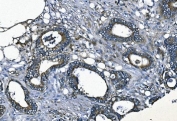 IHC staining of FFPE human rectal cancer with Elongation factor 2 antibody. HIER: boil tissue sections in pH8 EDTA for 20 min and allow to cool before testing.