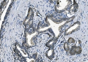 IHC staining of FFPE human prostate cancer with Elongation factor 2 antibody. HIER: boil tissue sections in pH8 EDTA for 20 min and allow to cool before testing.