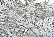 IHC staining of FFPE human breast cancer with Elongation factor 2 antibody. HIER: boil tissue sections in pH8 EDTA for 20 min and allow to cool before testing.