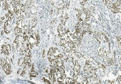 IHC staining of FFPE human lymphocytic tumor tissue with Interleukin 37 antibody. HIER: boil tissue sections in pH8 EDTA for 20 min and allow to cool before testing.