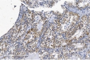 IHC staining of FFPE human renal clear cell carcinoma with KCNQ5 antibody. HIER: boil tissue sections in pH8 EDTA for 20 min and allow to cool before testing.