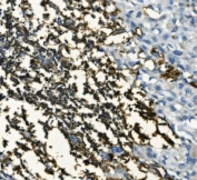 IHC staining of FFPE human B-lymphocytic tumor tissue with CD20 antibody. HIER: boil tissue sections in pH8 EDTA for 20 min and allow to cool before testing.