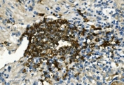 IHC staining of FFPE human gastric cancer with CD20 antibody. HIER: boil tissue sections in pH8 EDTA for 20 min and allow to cool before testing.