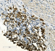 IHC staining of FFPE human rectal cancer with CD20 antibody. HIER: boil tissue sections in pH8 EDTA for 20 min and allow to cool before testing.