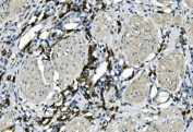 IHC staining of FFPE human bladder cancer tissue with CD20 antibody. HIER: boil tissue sections in pH8 EDTA for 20 min and allow to cool before testing.