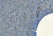 IHC staining of FFPE human skin cancer tissue with CD20 antibody. HIER: boil tissue sections in pH8 EDTA for 20 min and allow to cool before testing.