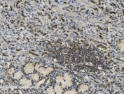 IHC staining of FFPE human poorly differentiated adenocarcinoma of the stomach with PARP antibody. HIER: boil tissue sections in pH8 EDTA for 20 min and allow to cool before testing.