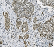 IHC staining of FFPE human adnexal serous adenocarcinoma with PARP antibody. HIER: boil tissue sections in pH8 EDTA for 20 min and allow to cool before testing.