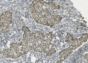 IHC staining of FFPE human breast cancer with PARP antibody. HIER: boil tissue sections in pH8 EDTA for 20 min and allow to cool before testing.