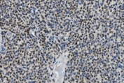 IHC staining of FFPE human lymphoma with PARP antibody. HIER: boil tissue sections in pH8 EDTA for 20 min and allow to cool before testing.