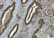 IHC staining of FFPE human gallbladder adenocarcinoma with Poly (ADP-ribose) polymerase 1 antibody. HIER: boil tissue sections in pH8 EDTA for 20 min and allow to cool before testing.