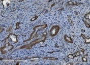 IHC staining of FFPE human gallbladder adenocarcinoma with PARP1 antibody. HIER: boil tissue sections in pH8 EDTA for 20 min and allow to cool before testing.