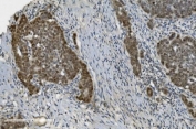 IHC staining of FFPE human ovarian serous adenocarcinoma with PARP1 antibody. HIER: boil tissue sections in pH8 EDTA for 20 min and allow to cool before testing.