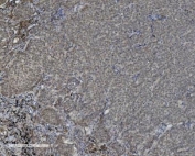 IHC staining of FFPE human lung cancer with PARP1 antibody. HIER: boil tissue sections in pH8 EDTA for 20 min and allow to cool before testing.