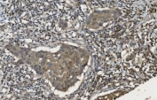 IHC staining of FFPE human breast cancer with Mannose Phosphate Isomerase antibody. HIER: boil tissue sections in pH8 EDTA for 20 min and allow to cool before testing.