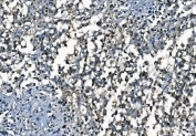 IHC staining of FFPE human pancreatic cancer with PORC-PI-1 antibody. HIER: boil tissue sections in pH8 EDTA for 20 min and allow to cool before testing.