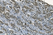 IHC staining of FFPE human breast cancer with PORC-PI-1 antibody. HIER: boil tissue sections in pH8 EDTA for 20 min and allow to cool before testing.