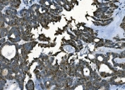 IHC staining of FFPE human ovarian cancer with PORC-PI-1 antibody. HIER: boil tissue sections in pH8 EDTA for 20 min and allow to cool before testing.