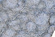 IHC staining of FFPE human esophageal squamous carcinoma with PORC-PI-1 antibody. HIER: boil tissue sections in pH8 EDTA for 20 min and allow to cool before testing.