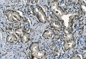 IHC staining of FFPE human prostate cancer with PORC-PI-1 antibody. HIER: boil tissue sections in pH8 EDTA for 20 min and allow to cool before testing.