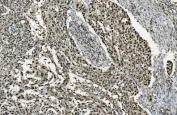 IHC staining of FFPE human lung cancer with TKT antibody. HIER: boil tissue sections in pH8 EDTA for 20 min and allow to cool before testing.