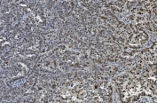 IHC staining of FFPE human ovarian cancer with TKT antibody. HIER: boil tissue sections in pH8 EDTA for 20 min and allow to cool before testing.