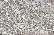 IHC staining of FFPE human pancreatic cancer with TKT antibody. HIER: boil tissue sections in pH8 EDTA for 20 min and allow to cool before testing.