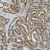 IHC staining of FFPE human thyroid cancer with Transketolase antibody. HIER: boil tissue sections in pH8 EDTA for 20 min and allow to cool before testing.