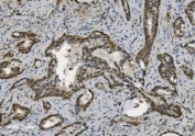 IHC staining of FFPE human gallbladder adenocarcinoma with U2AF65 antibody. HIER: boil tissue sections in pH8 EDTA for 20 min and allow to cool before testing.