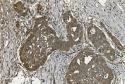IHC staining of FFPE human adnexal serous adenocarcinoma with U2AF65 antibody. HIER: boil tissue sections in pH8 EDTA for 20 min and allow to cool before testing.