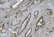 IHC staining of FFPE human gallbladder adenocarcinoma with U2AF2 antibody. HIER: boil tissue sections in pH8 EDTA for 20 min and allow to cool before testing.