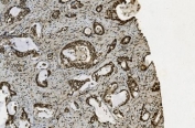IHC staining of FFPE human gallbladder adenocarcinoma with U2AF2 antibody. HIER: boil tissue sections in pH8 EDTA for 20 min and allow to cool before testing.