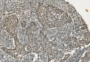 IHC staining of FFPE human breast cancer with U2AF2 antibody. HIER: boil tissue sections in pH8 EDTA for 20 min and allow to cool before testing.