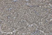 IHC staining of FFPE human lung cancer with U2AF2 antibody. HIER: boil tissue sections in pH8 EDTA for 20 min and allow to cool before testing.