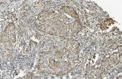 IHC staining of FFPE human pancreatic cancer with MCM5 antibody. HIER: boil tissue sections in pH8 EDTA for 20 min and allow to cool before testing.