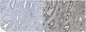 IHC staining of FFPE human gallbladder adenocarcinoma with (right) and without (left) MCM5 antibody. HIER: boil tissue sections in pH8 EDTA for 20 min and allow to cool before testing.