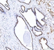 IHC staining of FFPE human prostatic acinar adenocarcinoma tissue with DDX1 antibody. HIER: boil tissue sections in pH8 EDTA for 20 min and allow to cool before testing.