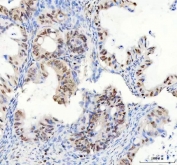 IHC staining of FFPE human ovarian cancer tissue with DDX1 antibody. HIER: boil tissue sections in pH8 EDTA for 20 min and allow to cool before testing.