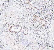 IHC staining of FFPE human colorectal adenocarcinoma tissue with DDX1 antibody. HIER: boil tissue sections in pH8 EDTA for 20 min and allow to cool before testing.
