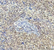 IHC staining of FFPE human squamous cell cervical carcinoma tissue with DDX1 antibody. HIER: boil tissue sections in pH8 EDTA for 20 min and allow to cool before testing.