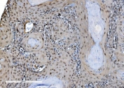 IHC staining of FFPE human esophageal squamous carcinoma with DDX1 antibody. HIER: boil tissue sections in pH8 EDTA for 20 min and allow to cool before testing.