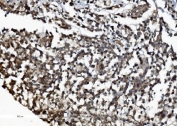 IHC staining of FFPE human pancreatic cancer with DDX1 antibody. HIER: boil tissue sections in pH8 EDTA for 20 min and allow to cool before testing.