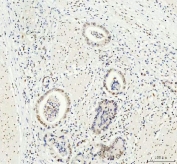 IHC staining of FFPE human rectum adenocarcinoma tissue with DDX1 antibody. HIER: boil tissue sections in pH8 EDTA for 20 min and allow to cool before testing.