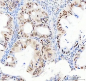 IHC staining of FFPE human ovarian serous adenocarcinoma tissue with DDX1 antibody. HIER: boil tissue sections in pH8 EDTA for 20 min and allow to cool before testing.