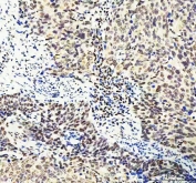 IHC staining of FFPE human cervical squamous carcinoma tissue with DDX1 antibody. HIER: boil tissue sections in pH8 EDTA for 20 min and allow to cool before testing.