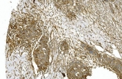 IHC staining of FFPE human ovarian serous adenocarcinoma with TUBA1 antibody. HIER: boil tissue sections in pH8 EDTA for 20 min and allow to cool before testing.