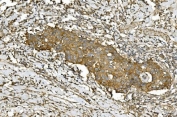 IHC staining of FFPE human breast cancer with TUBA1 antibody. HIER: boil tissue sections in pH8 EDTA for 20 min and allow to cool before testing.